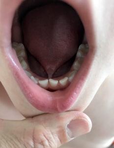 What is tongue-tie in children?
